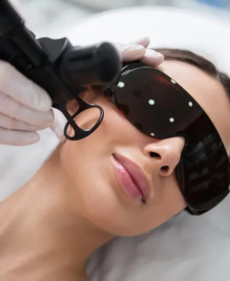 CO2 Fractional Laser Treatment
