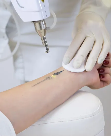 Tattoo Removal Laser Treatment