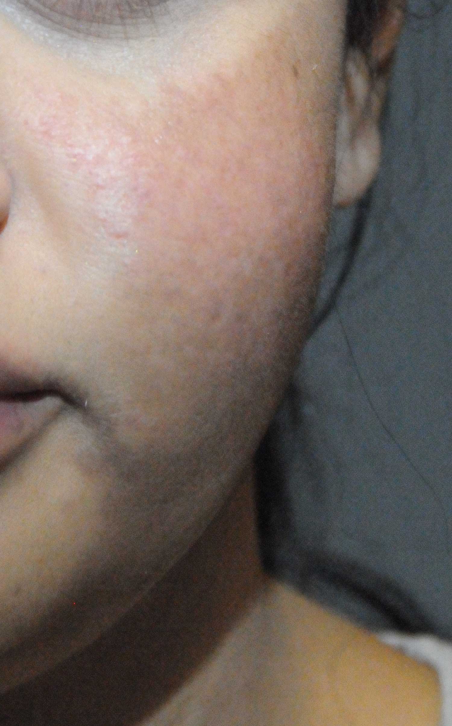 Before Acne Scar Treatment