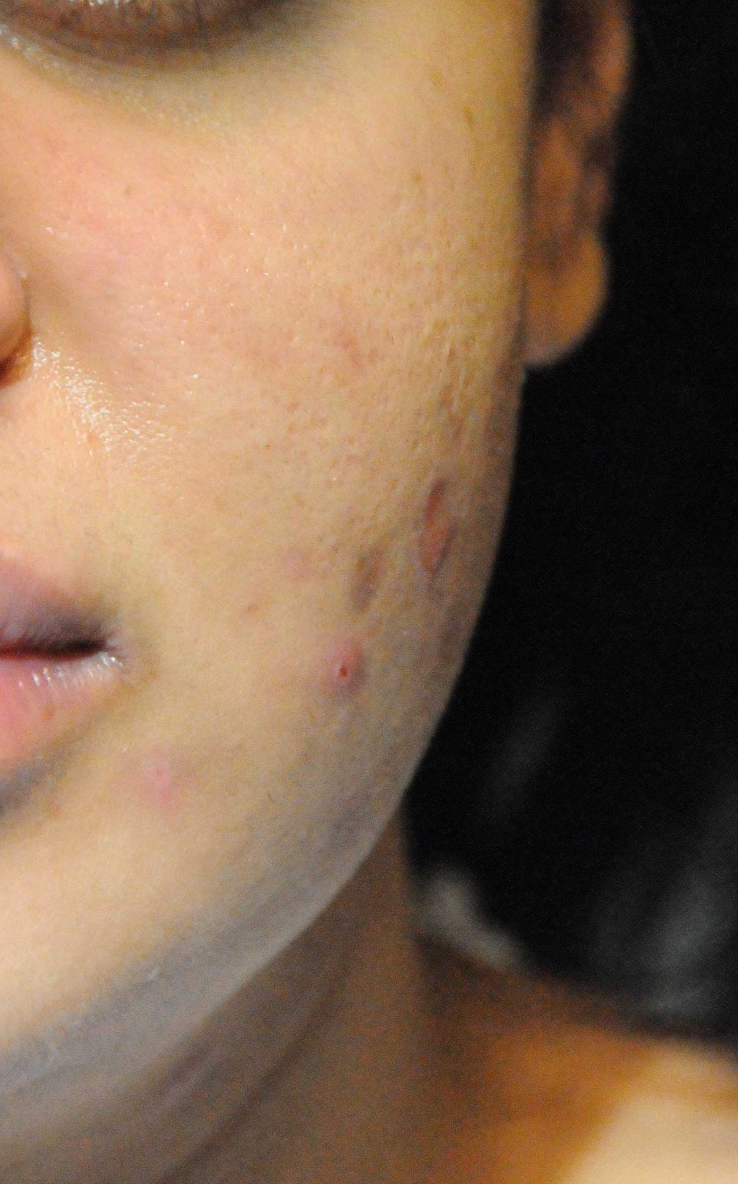 After Acne Scar Treatment