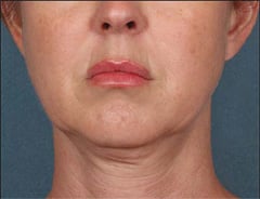 Before Face Mesotherapy