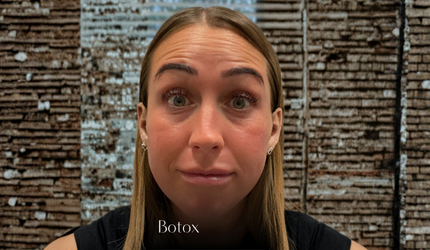 After Face Botox