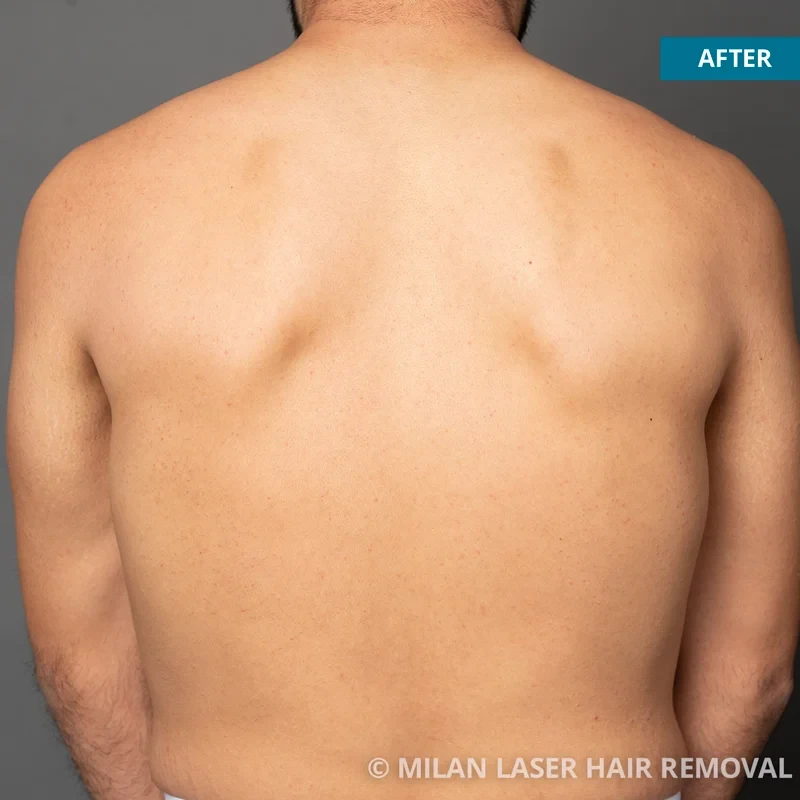 Before Laser Hair Removal