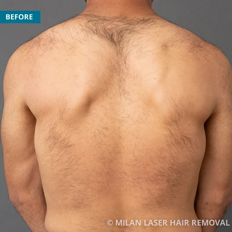 After Laser Hair Removal