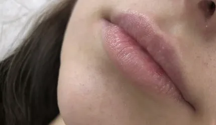 Before Lip Fillers