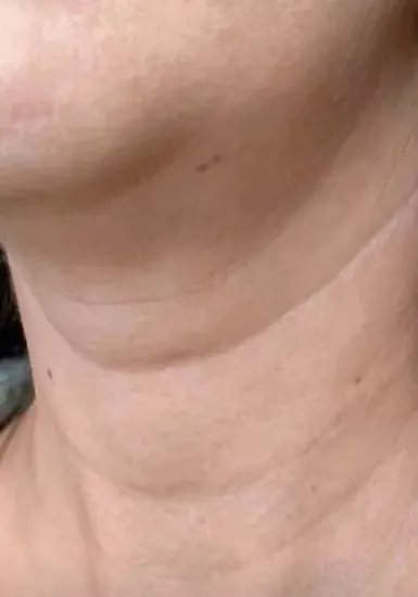 Before Masseter Botox