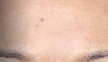 After Pigmentation Treatment