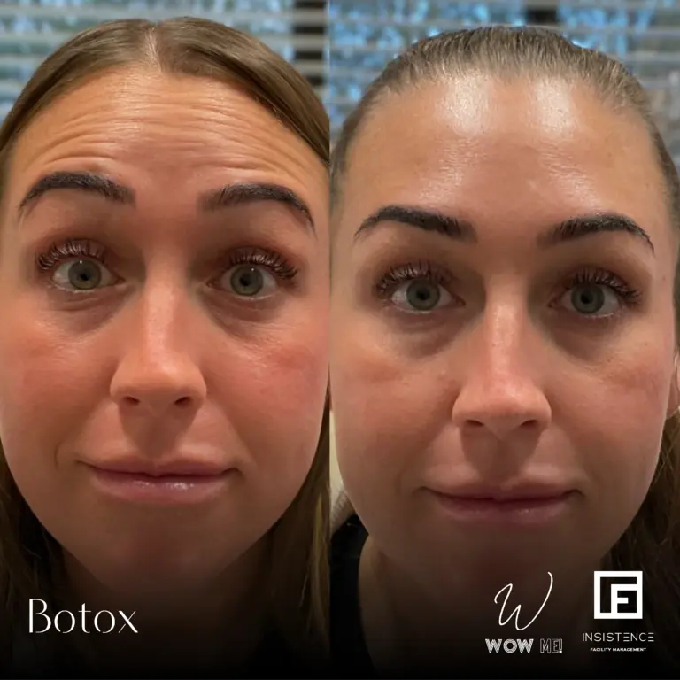 Botox Case #12