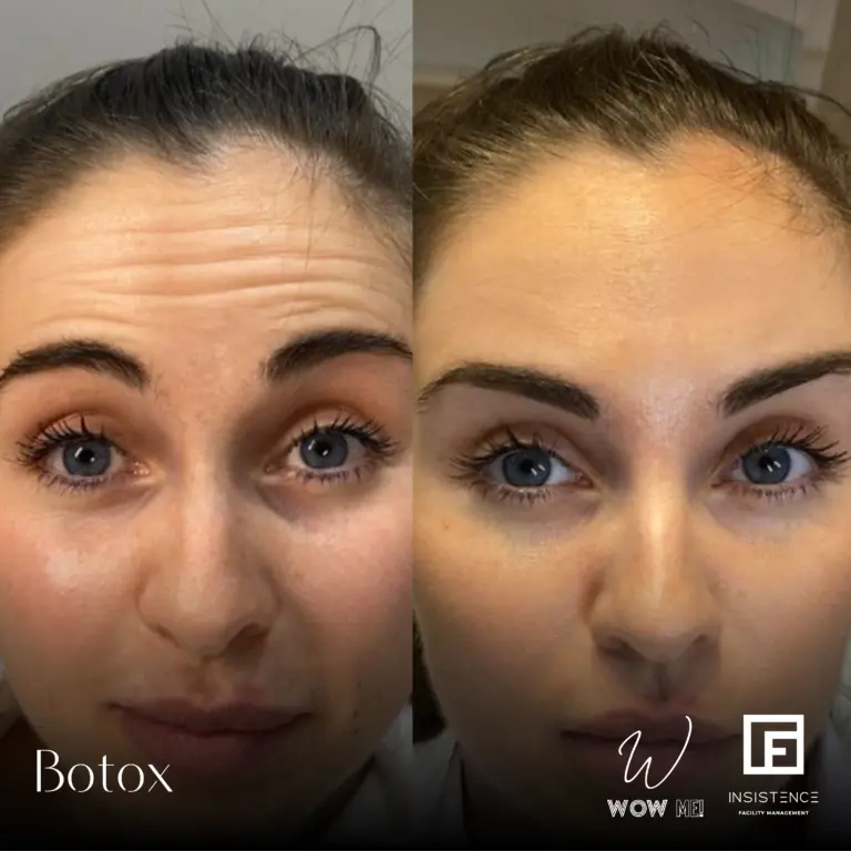 Botox Case #16