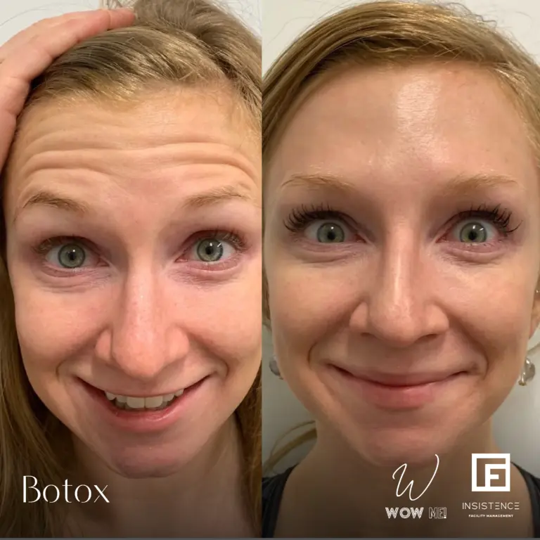 Botox Case #22