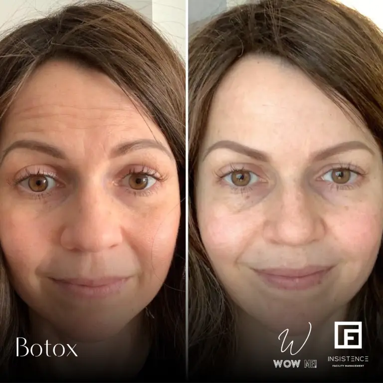 Botox Case #31
