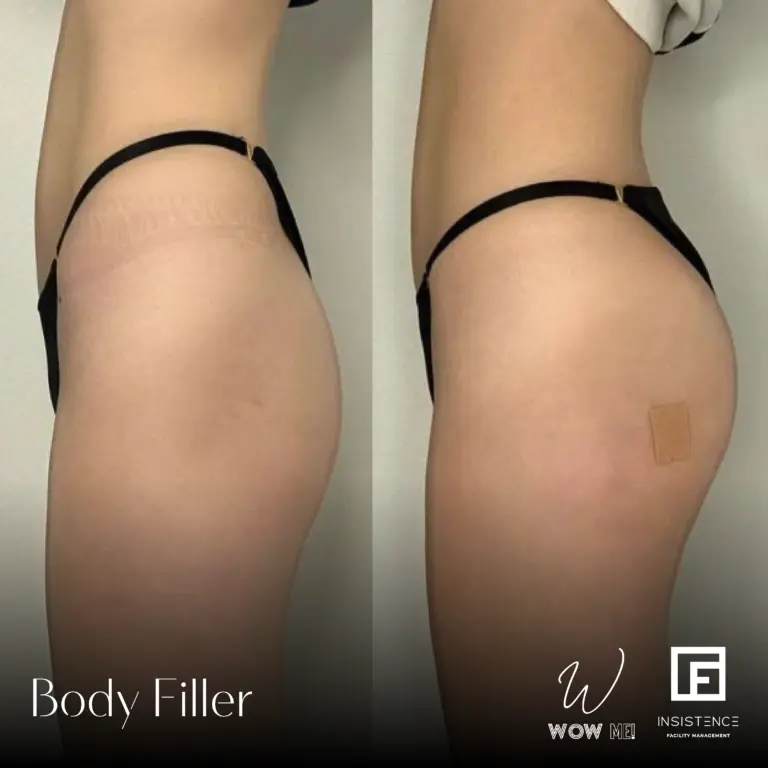 Butt Filler Case #01