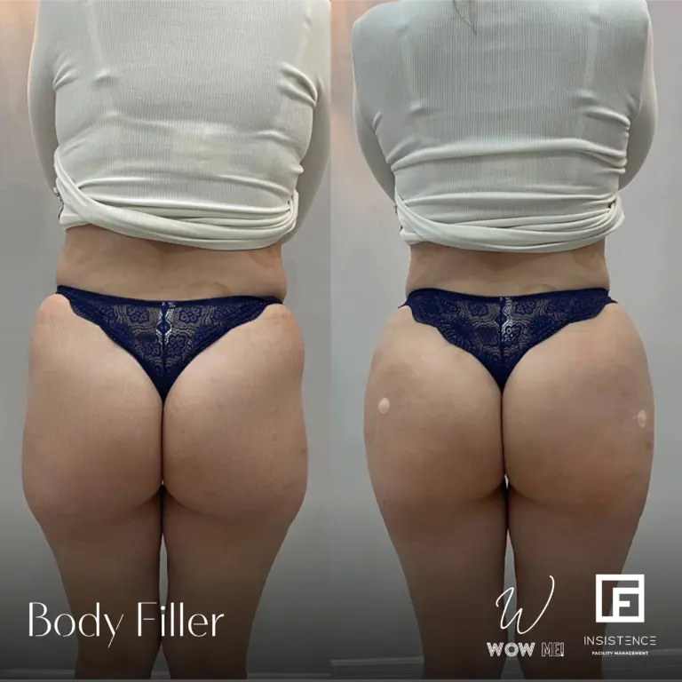 Butt Filler Case #02