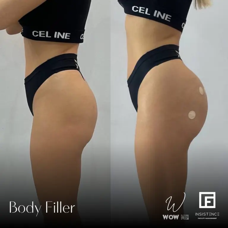 Butt Filler Case #03