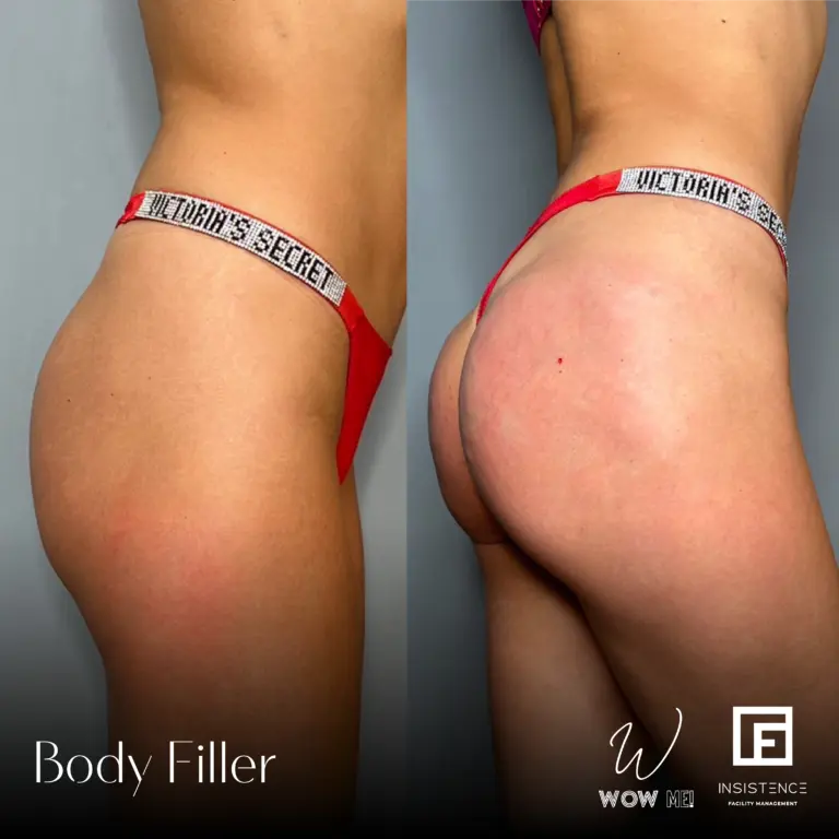 Butt Filler Case #04