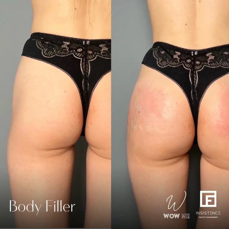 Butt Filler Case #05-2