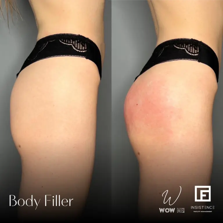 Butt Filler Case #05