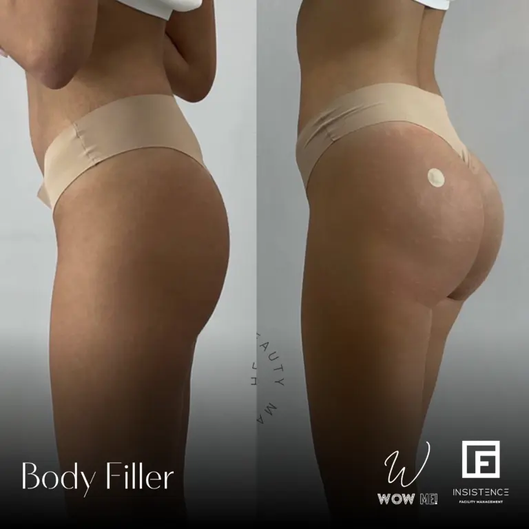 Butt Filler Case #06