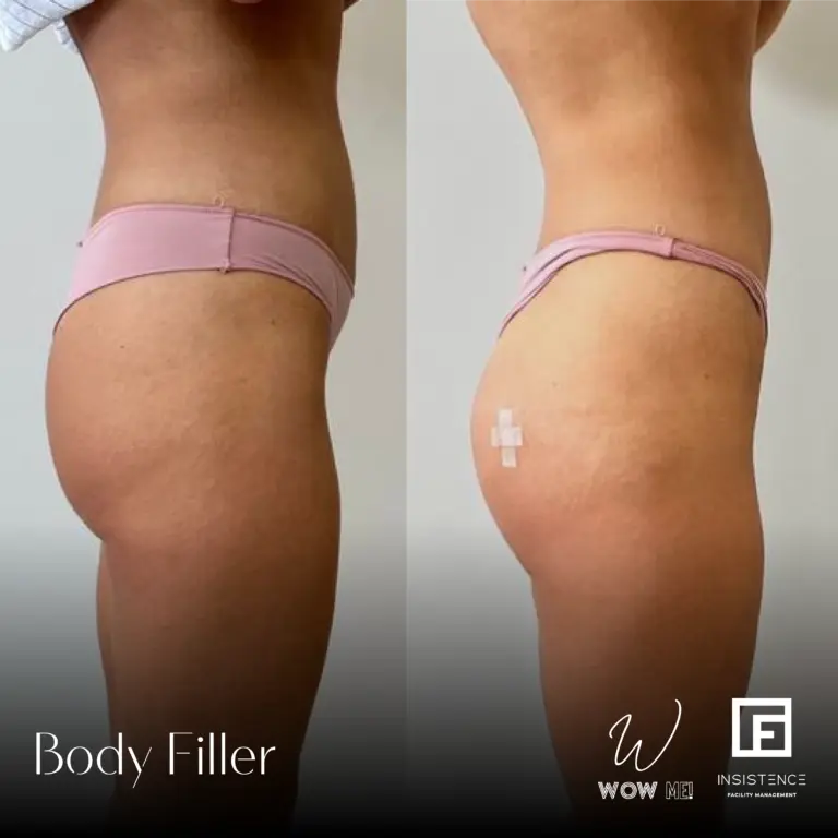 Butt Filler Case #07