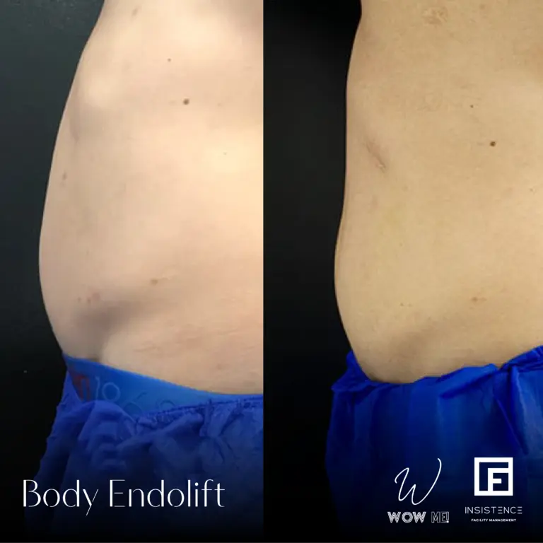 Endolift Case #12 copy 3