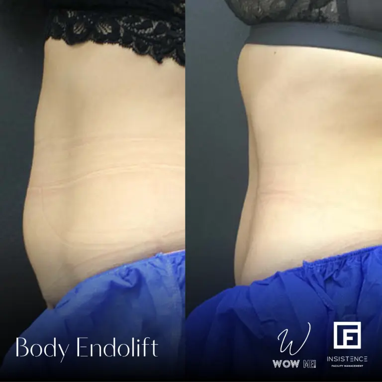 Endolift Case #31 5 Session