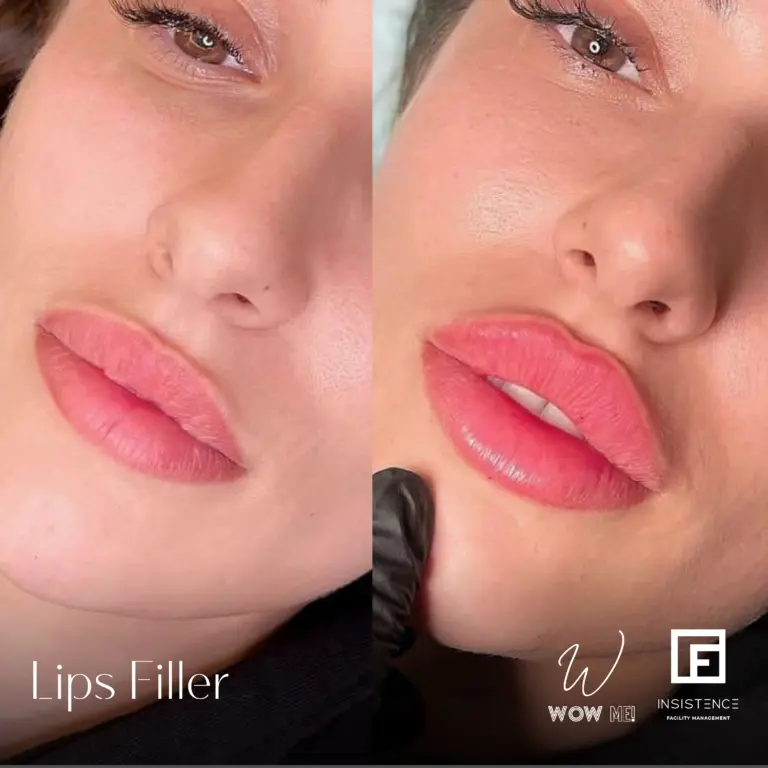 Lips Filler Case #01