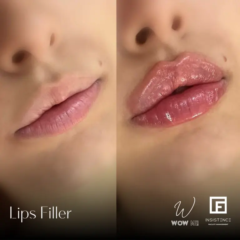 Lips Filler Case #02