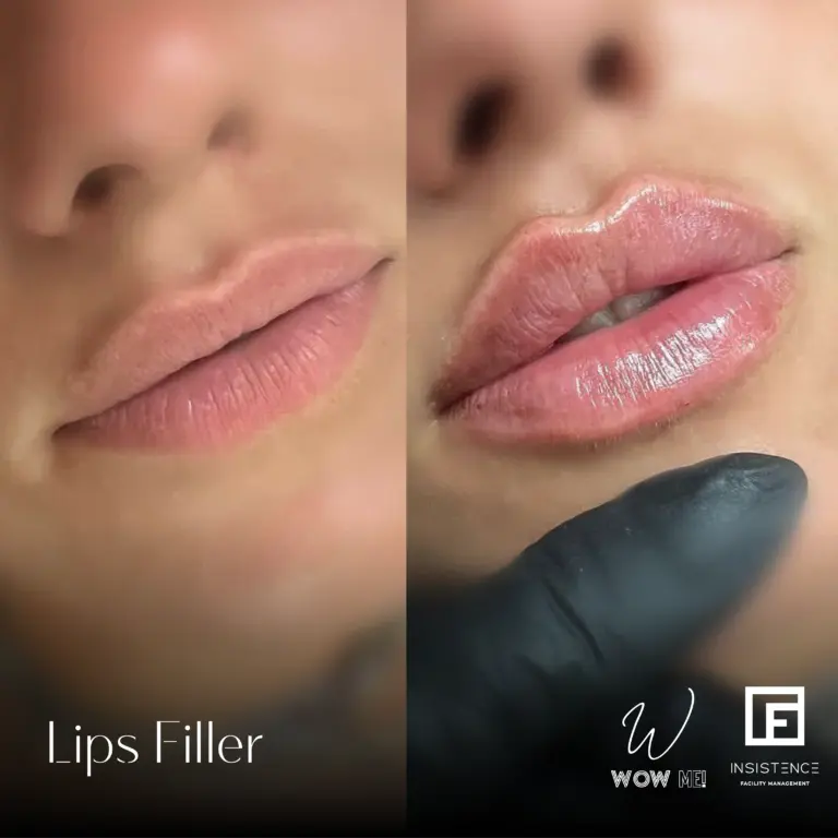 Lips Filler Case #03