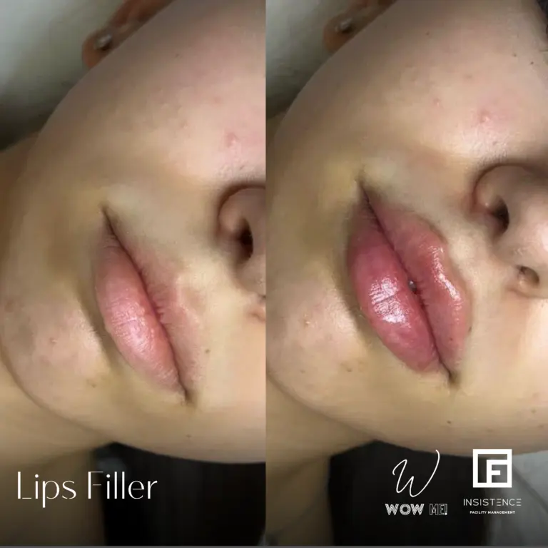 Lips Filler Case #04