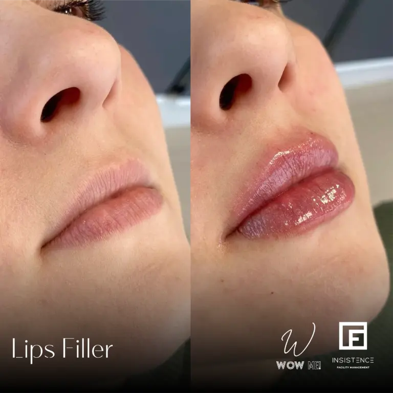 Lips Filler Case #05
