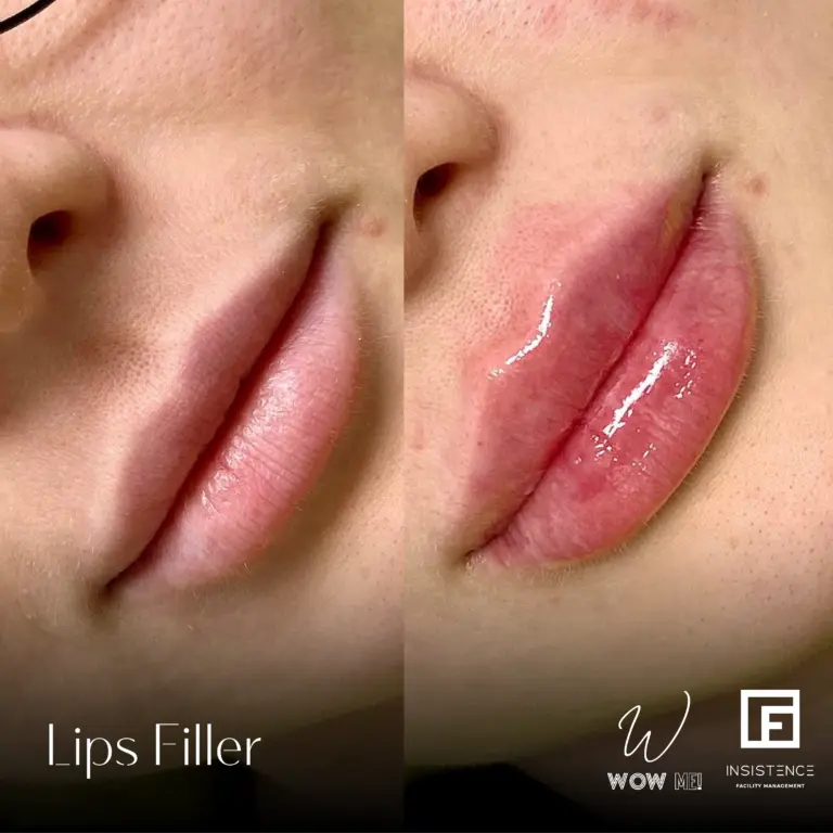 Lips Filler Case #06