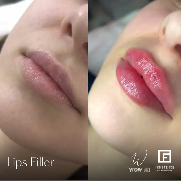 Lips Filler Case #07