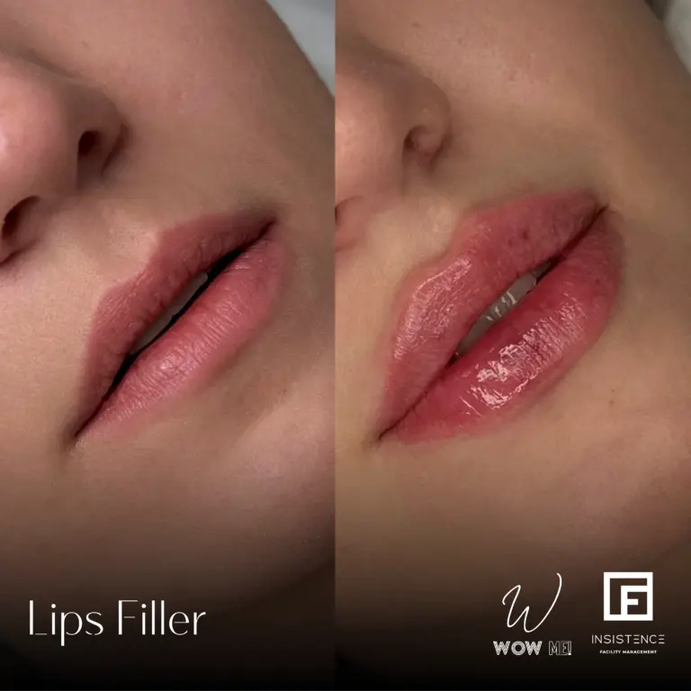 Lips Filler Case #08