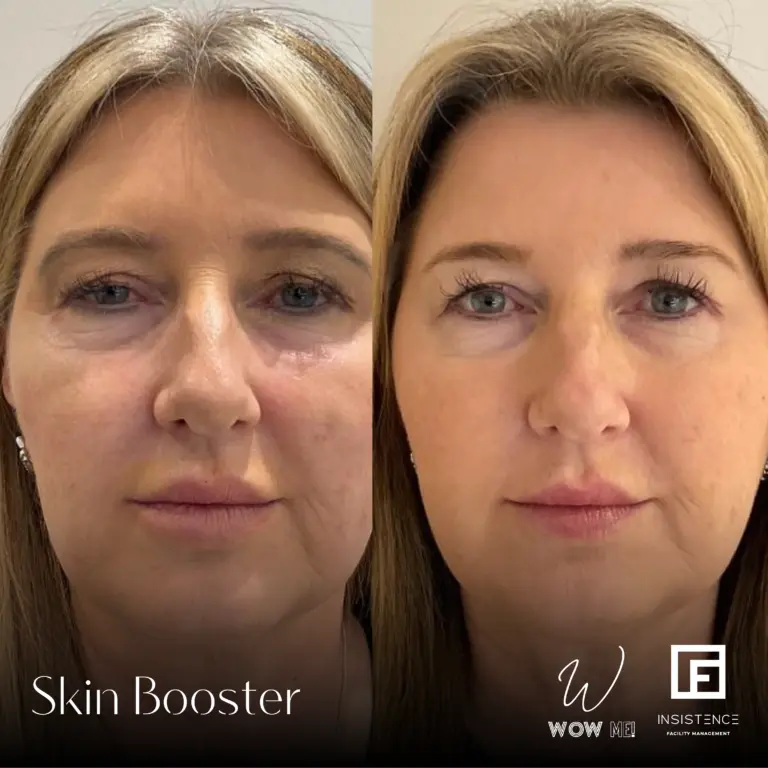 Skin Booster 2