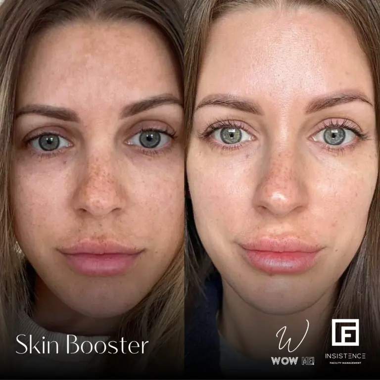 Skin Booster 9
